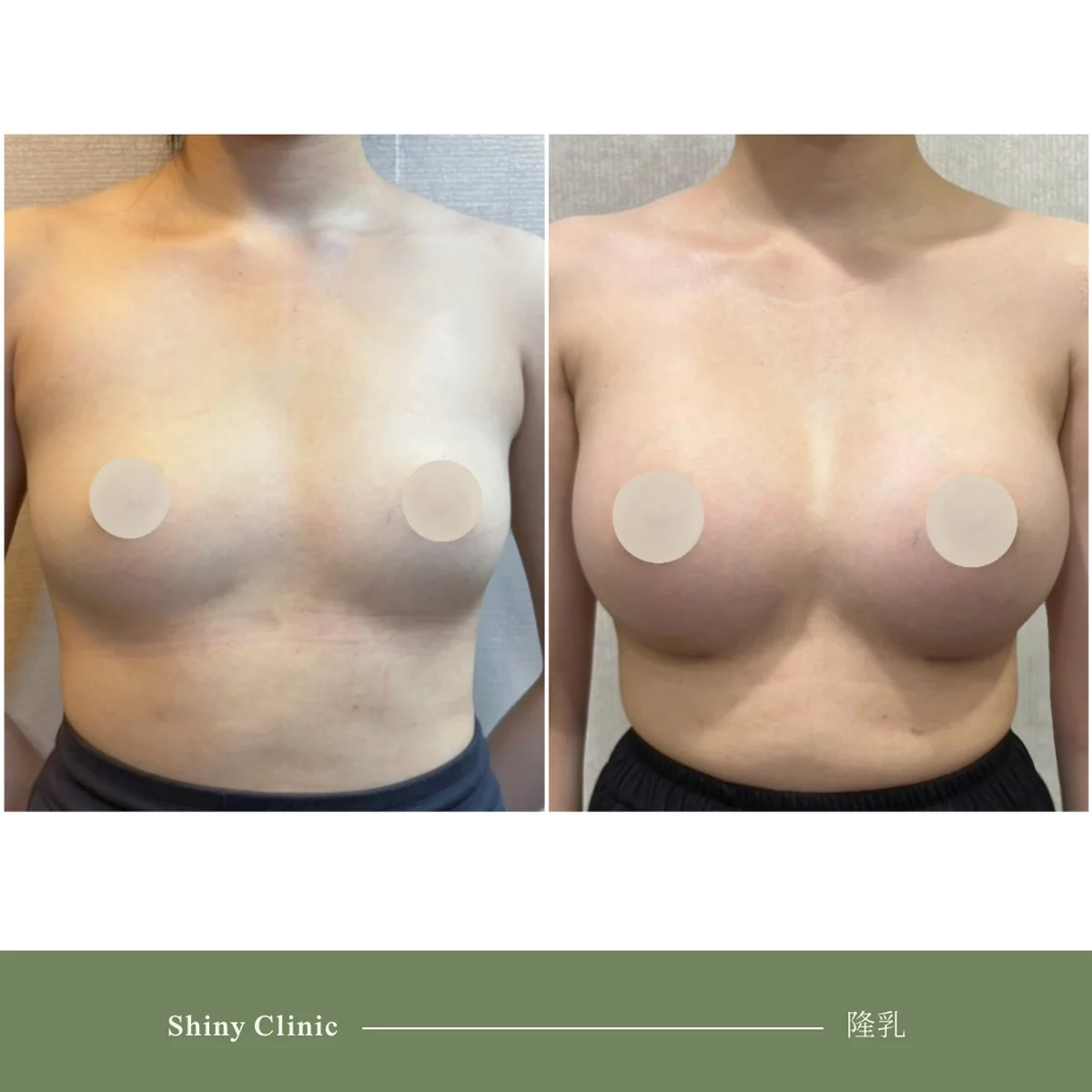 隆乳手術案例 11