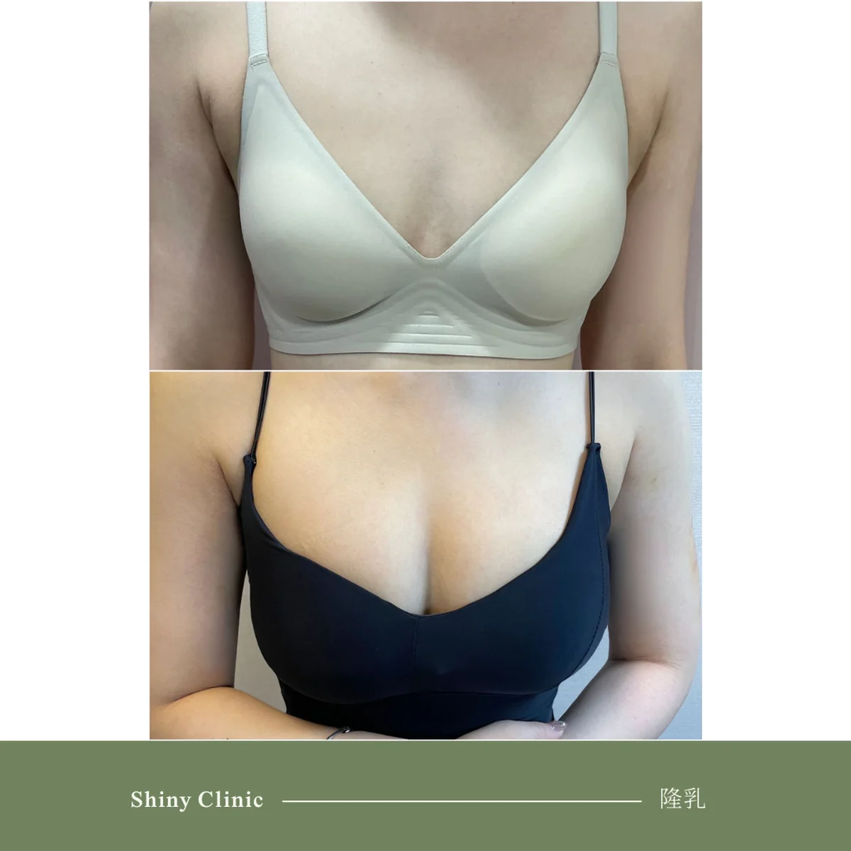 隆乳手術案例 21
