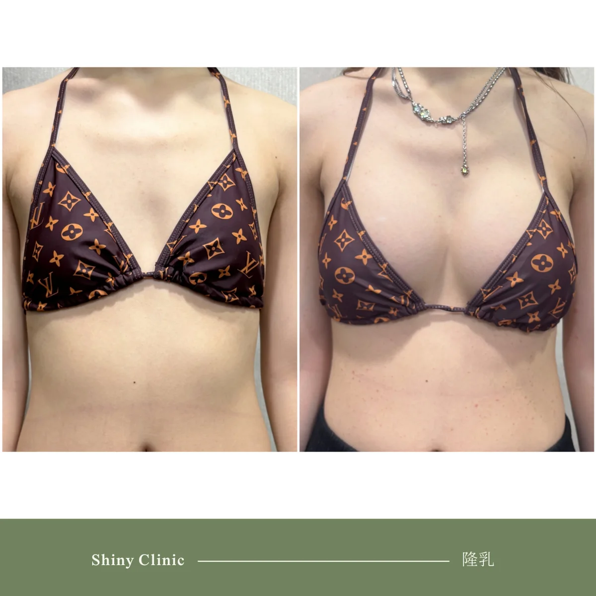 隆乳手術案例 23