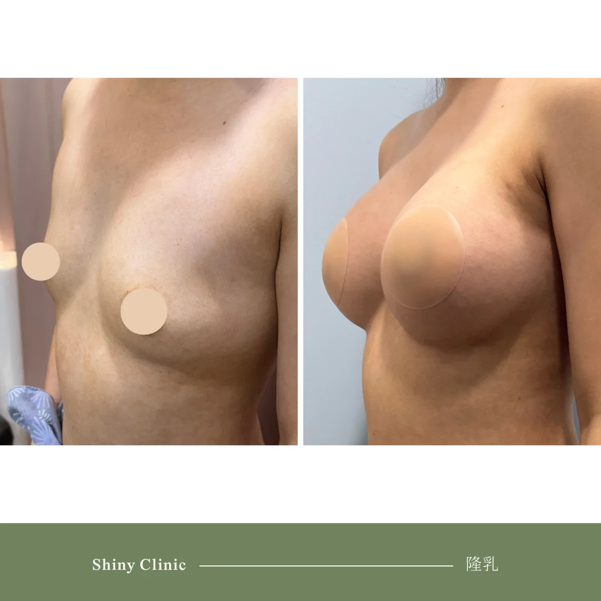 隆乳手術案例 36