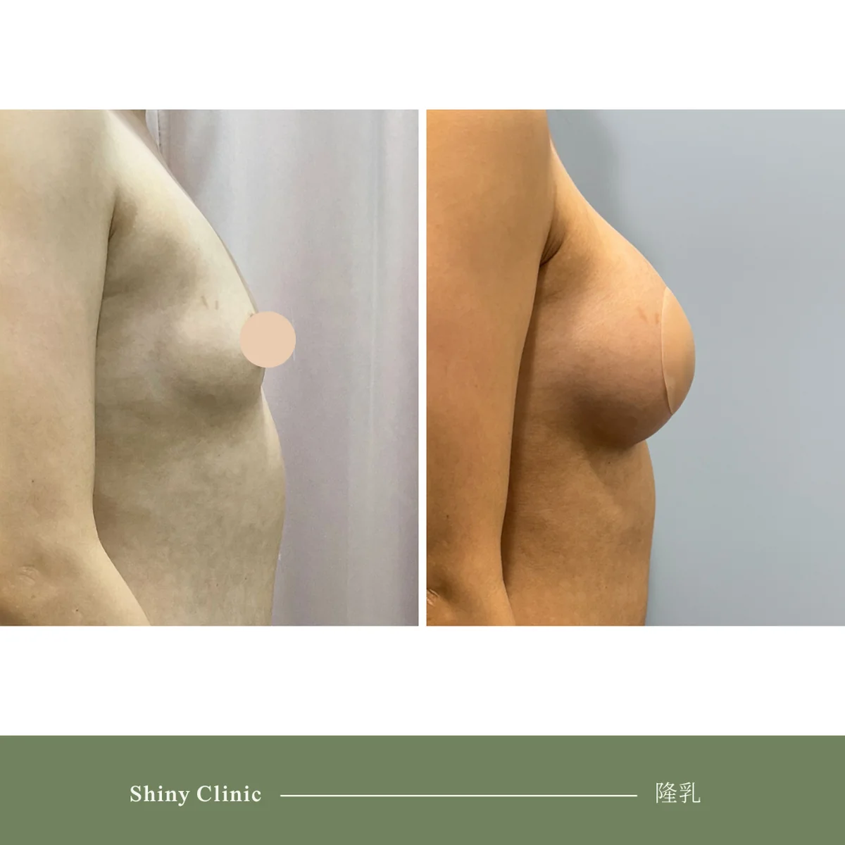 隆乳手術案例 38
