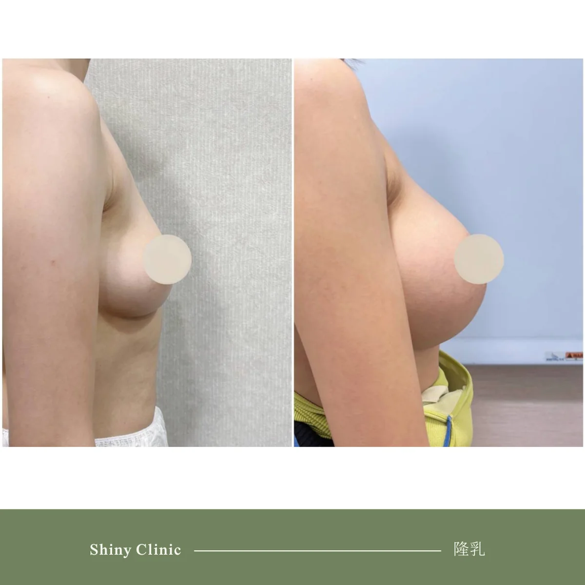 隆乳手術案例 44