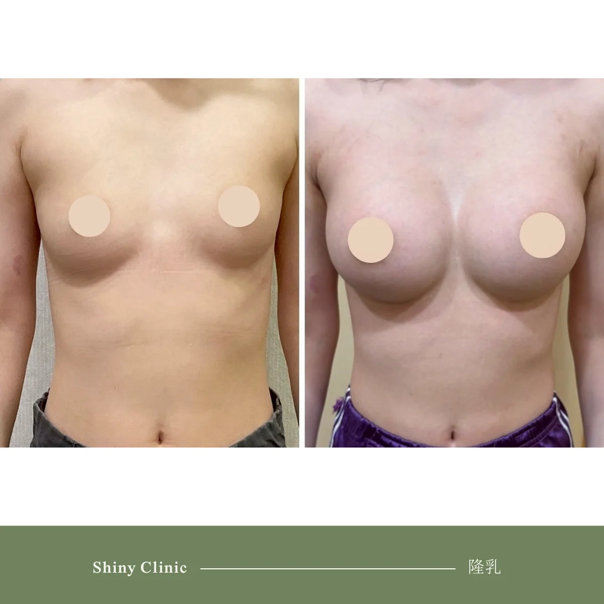 隆乳手術案例 46