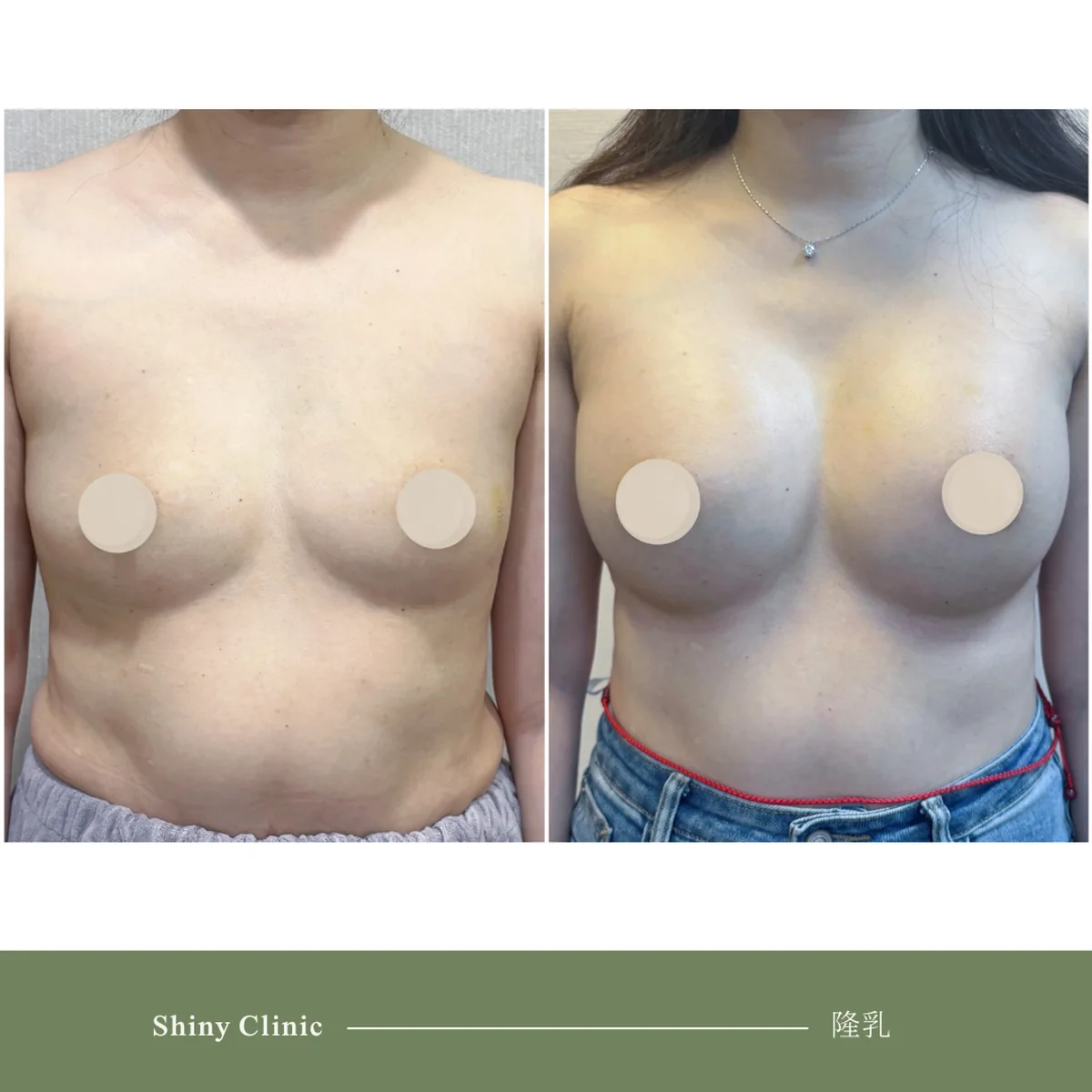 隆乳手術案例 79