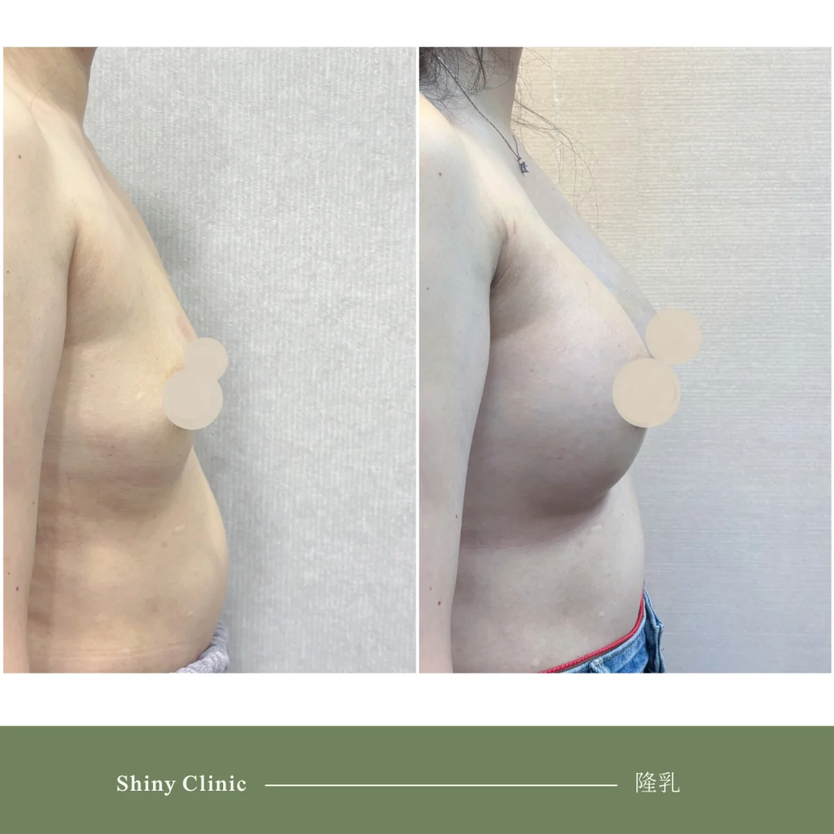 隆乳手術案例 82