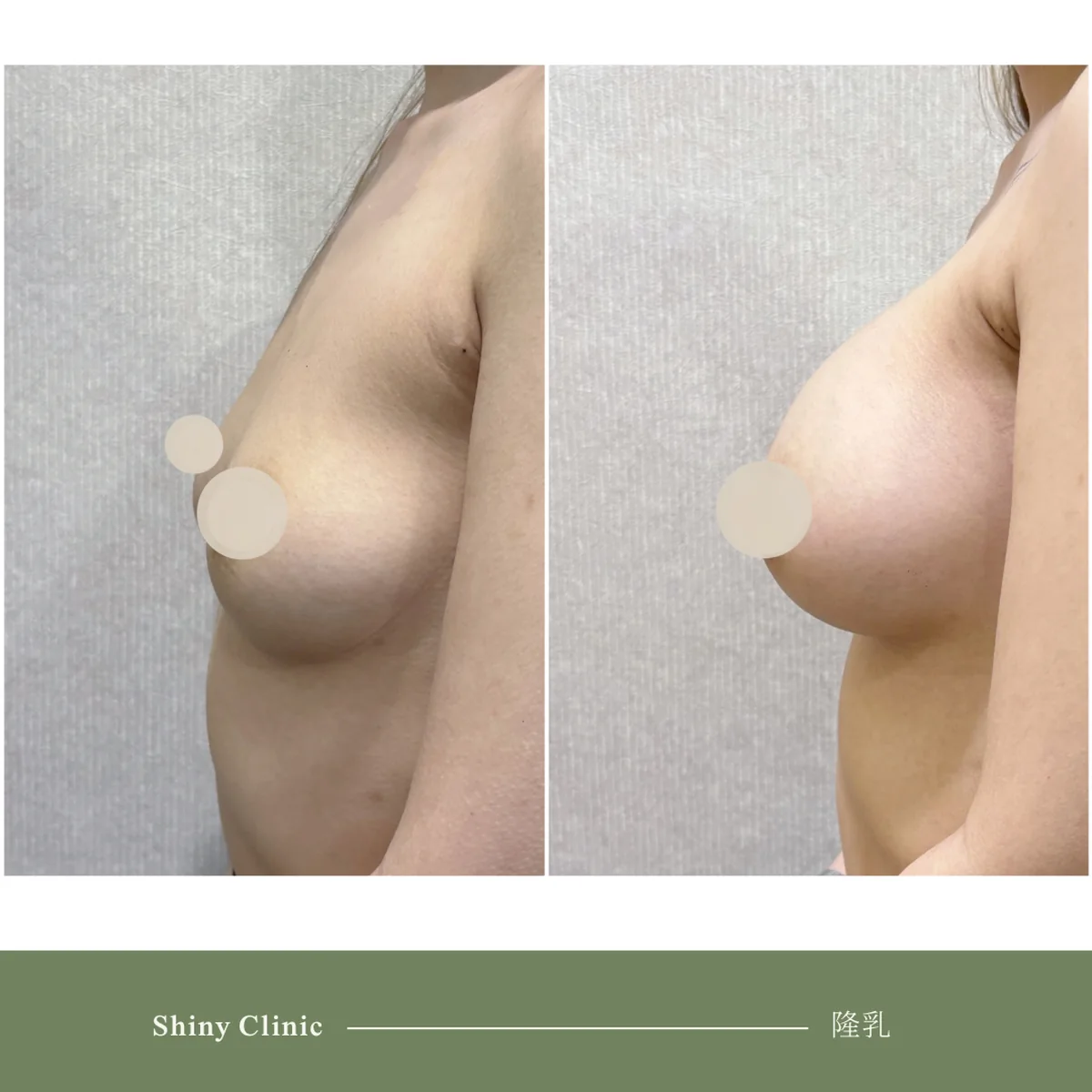 隆乳手術案例 87