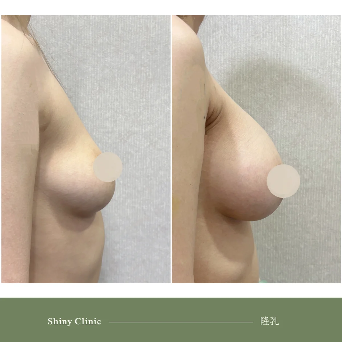 隆乳手術案例 88