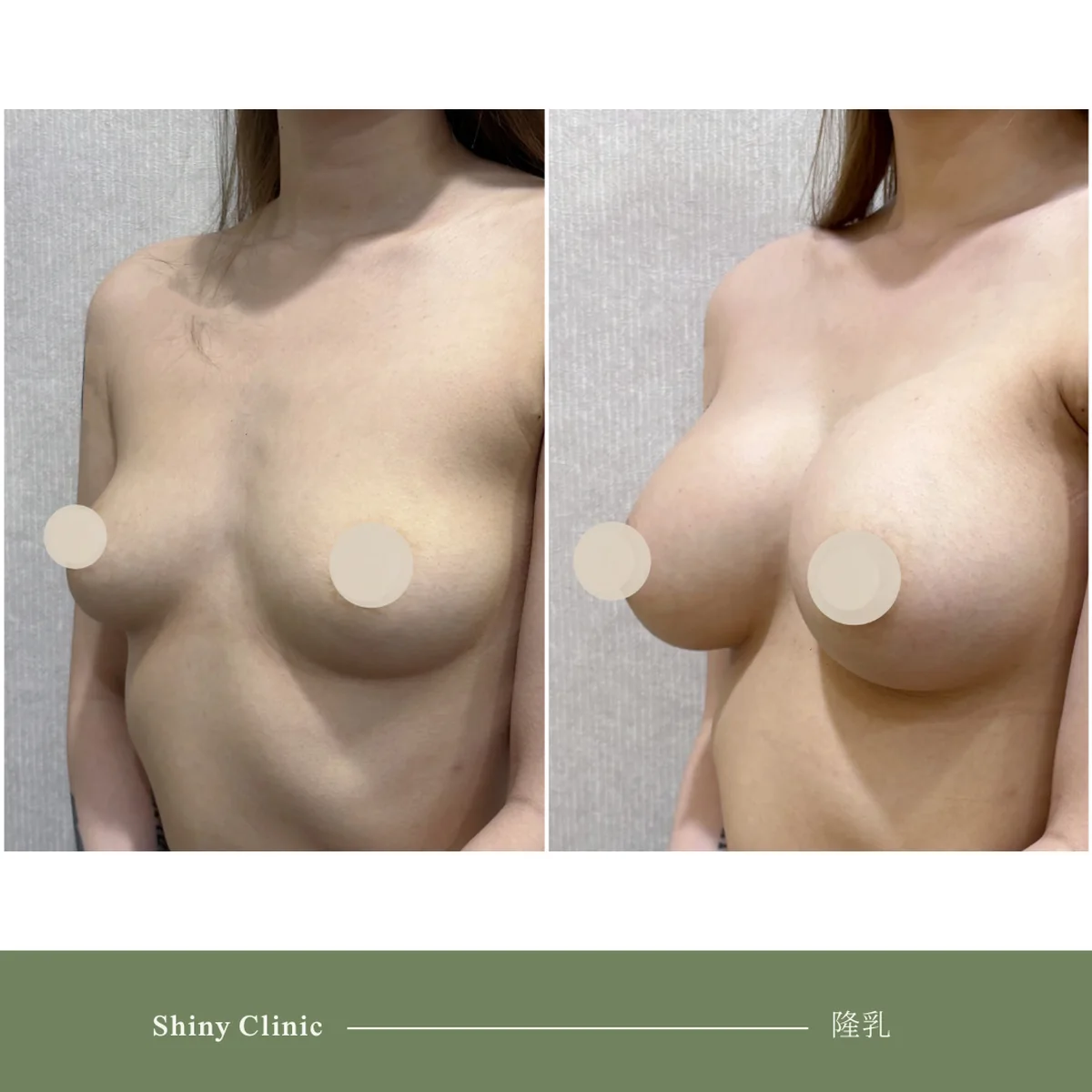 隆乳手術案例 90