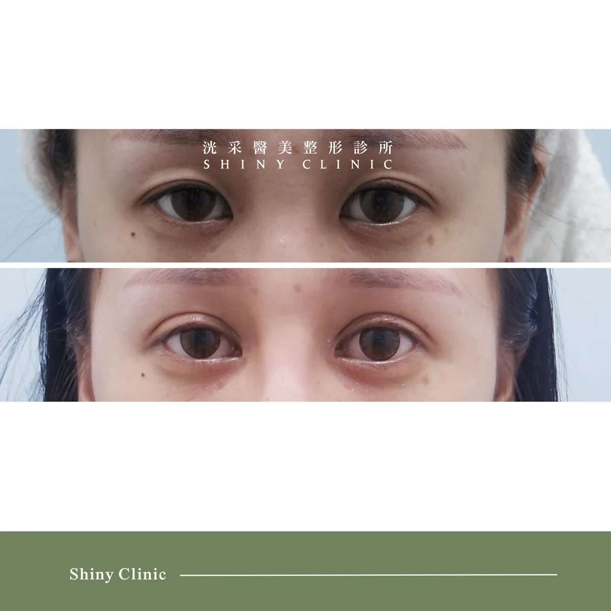 雙眼皮/提眼肌案例 1