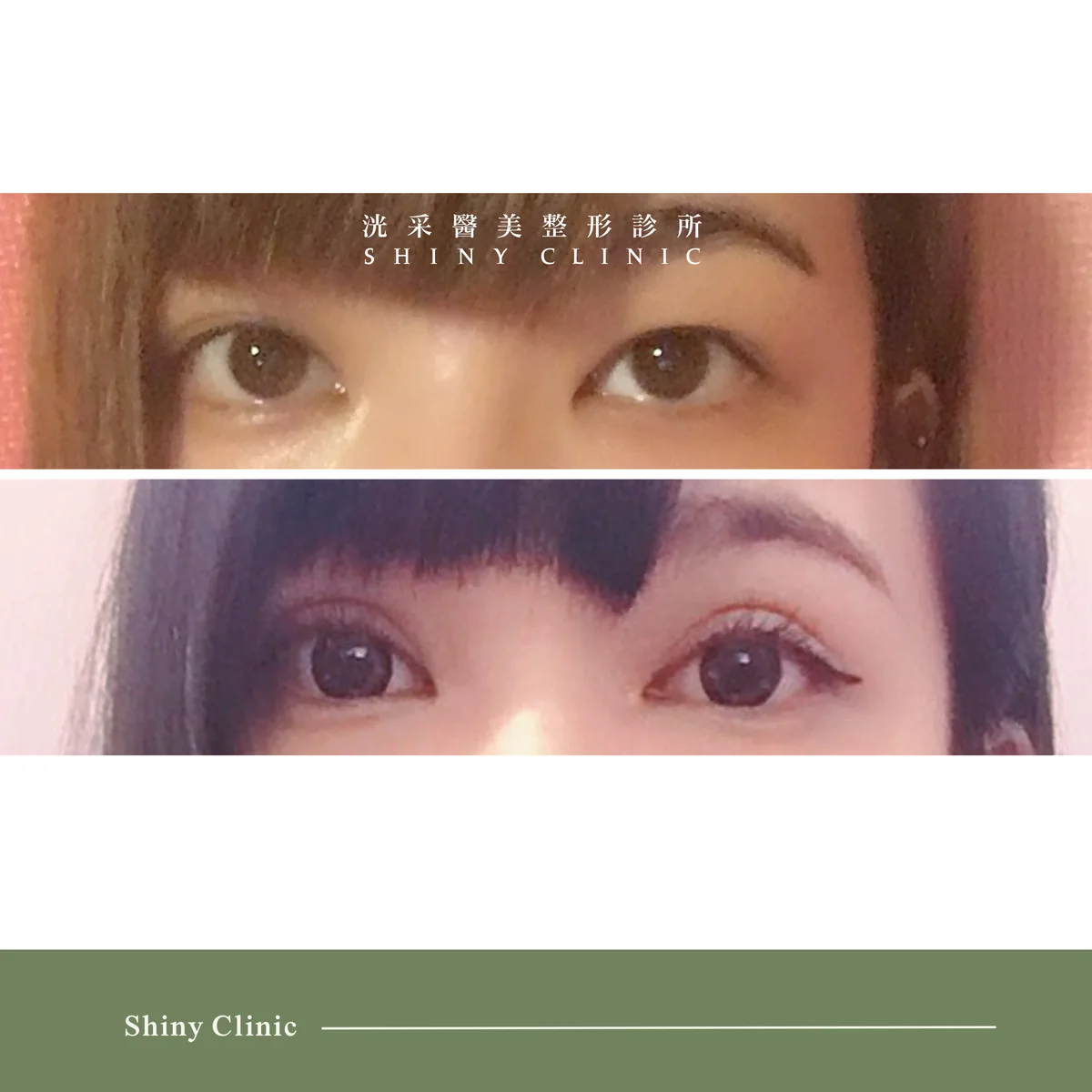 雙眼皮/提眼肌案例 6
