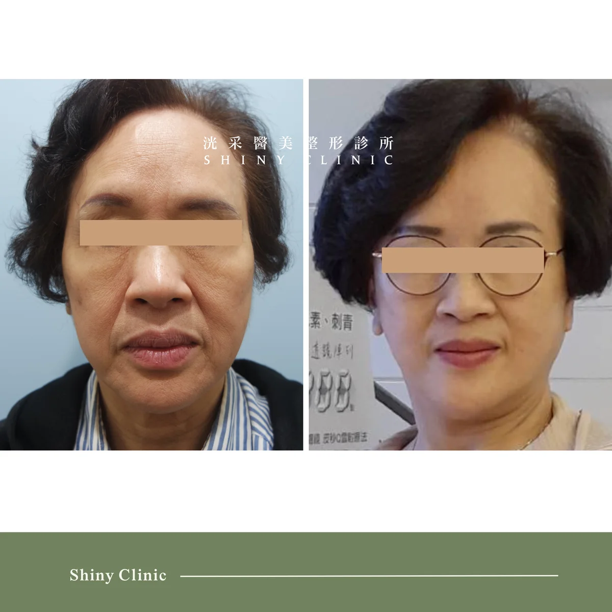 中下臉拉皮案例 1