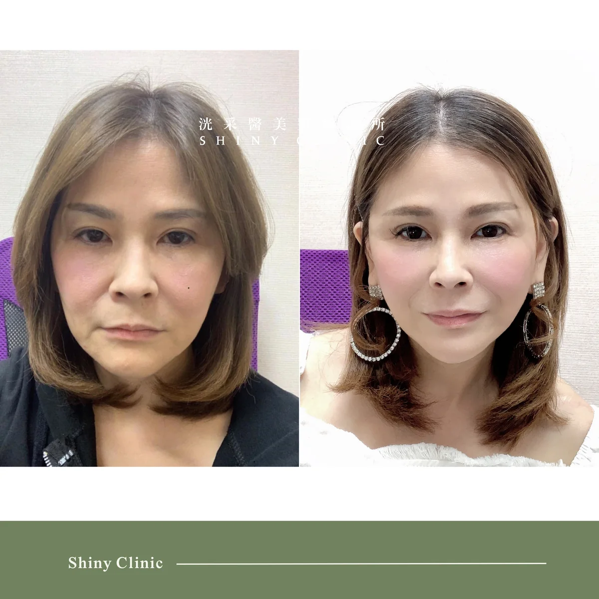 中下臉拉皮案例 2