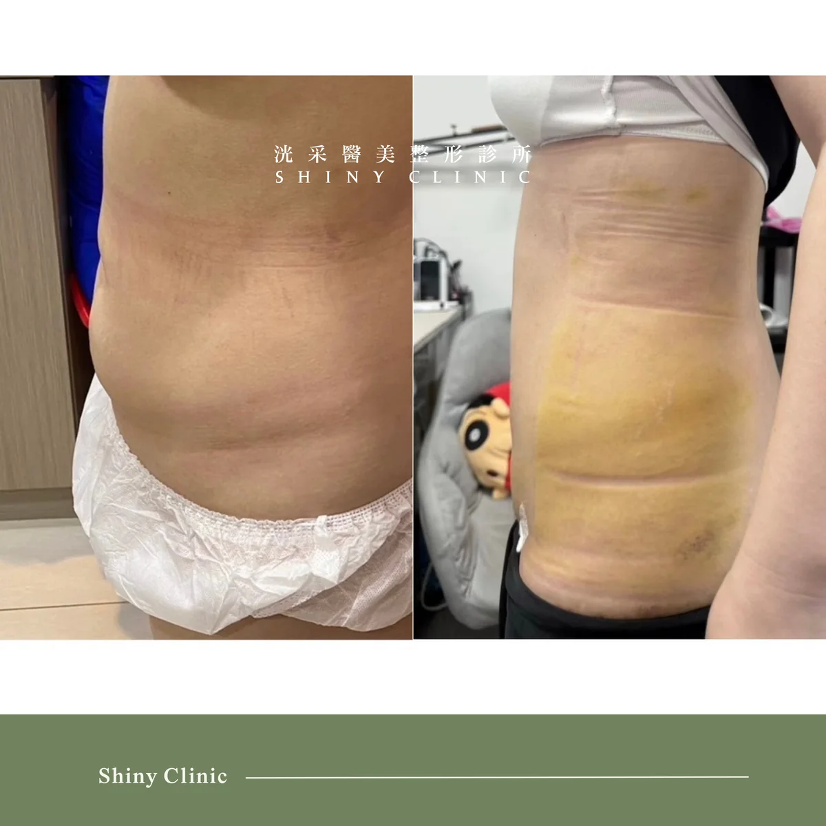 抽脂手術案例預覽