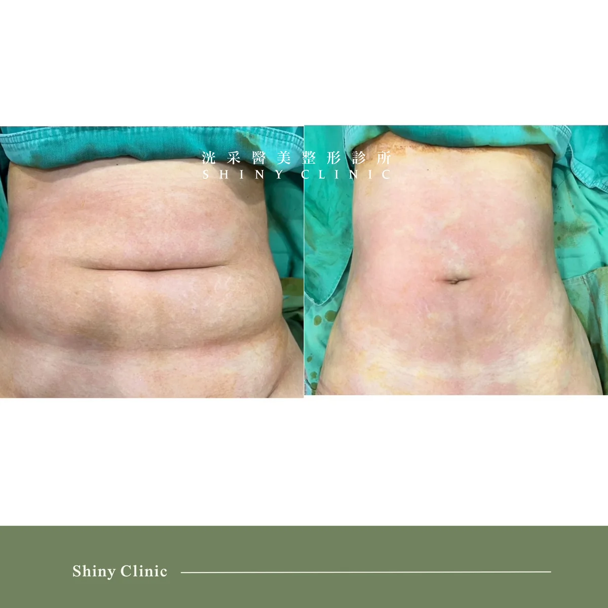 抽脂手術案例 2