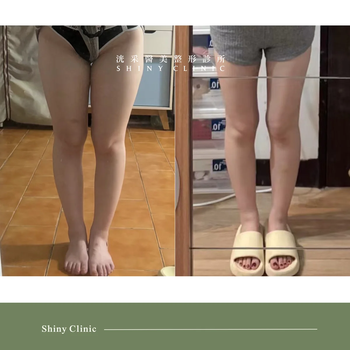 抽脂手術案例 5