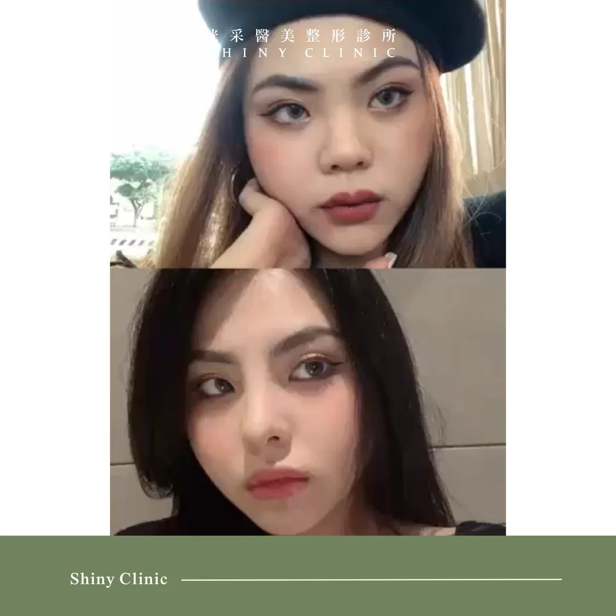 自體軟骨隆鼻案例 5