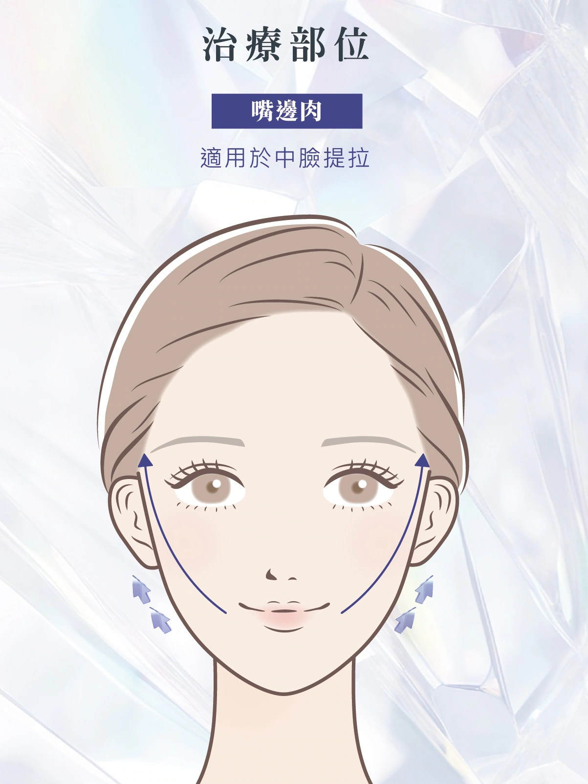 Meteora Thread美特拉埋線拉提療程補充圖 1