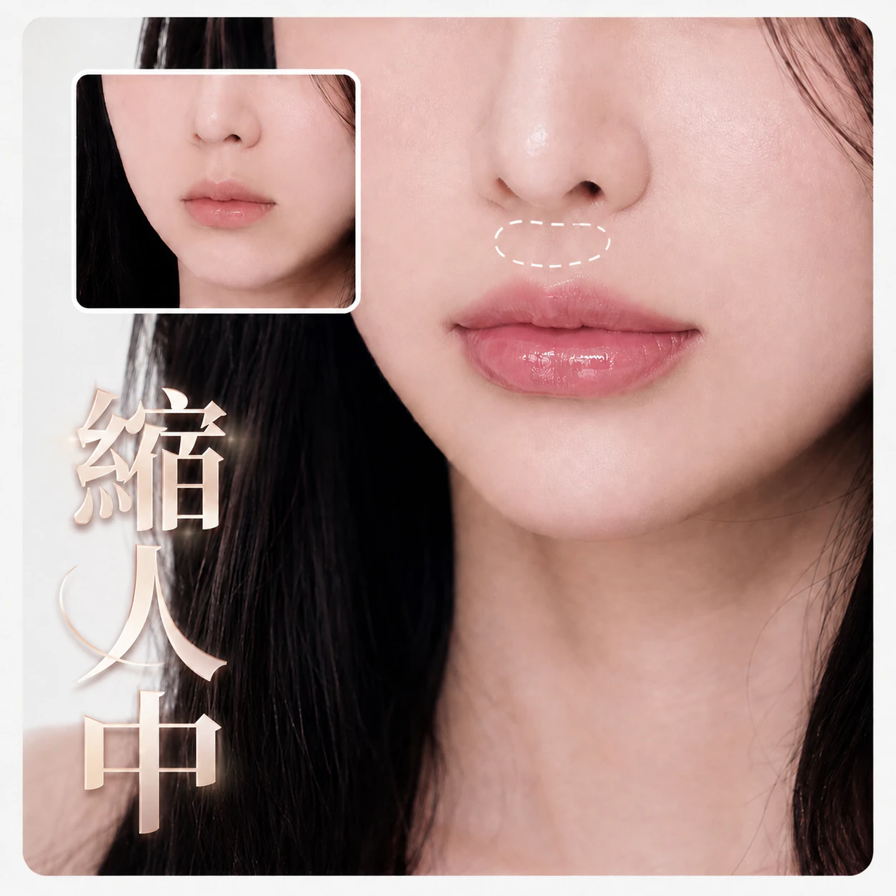 縮人中|整形外科